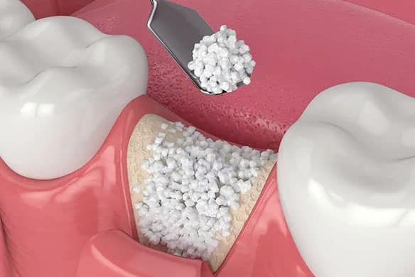 Bone-Grafting