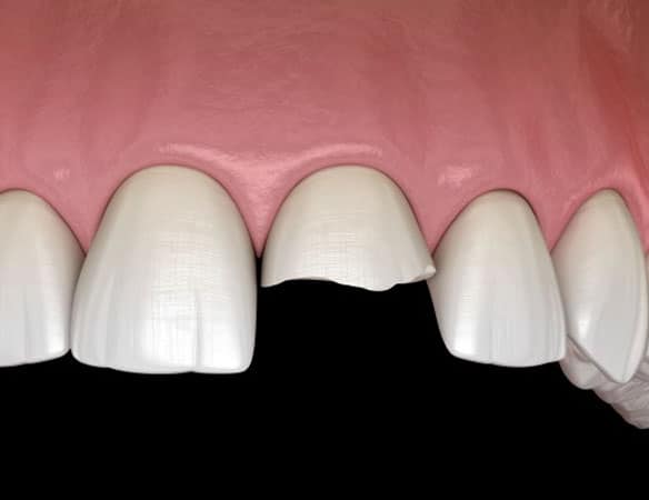 Cracked-tooth-restoration-and-traumatic-dental