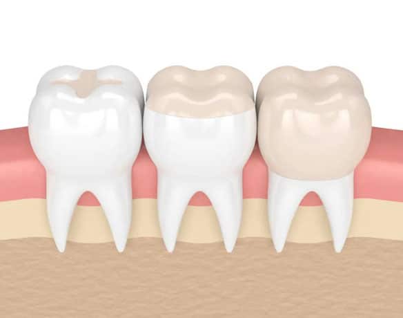 Dental-Crown-Placement-Procedure