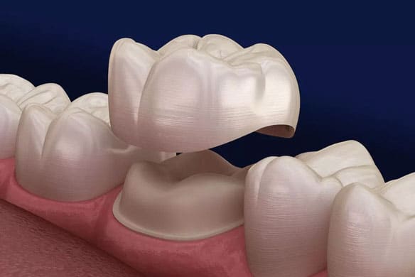 Dental-Crown-Replacement
