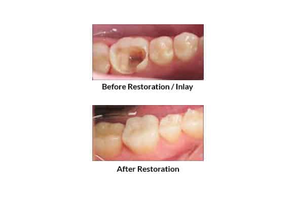 Dental Inlays & Onlays | Gentle Family Dentist Avondale and Dental Implants