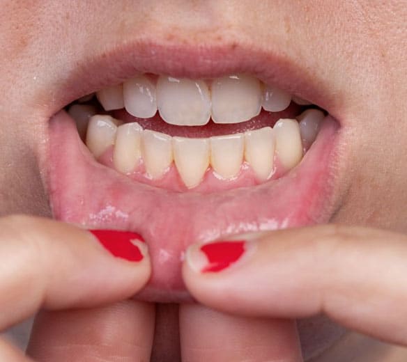 Gum-reduction-procedures-include