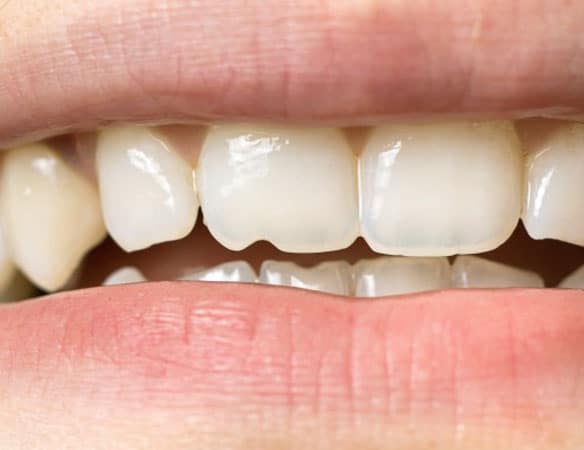 Traumatic Root Injury | Gentle Family Dentist Avondale and Dental Implants