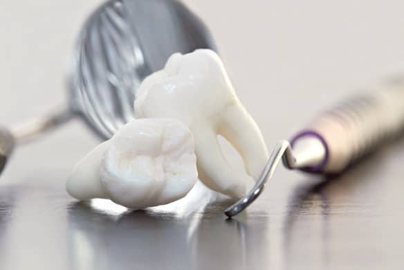 After-Extracting-A-Tooth