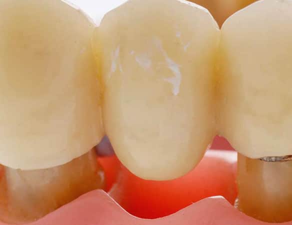 Removable-Dental-Bridge-Placement-Procedure