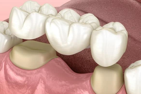 Fixed-Dental-Bridge