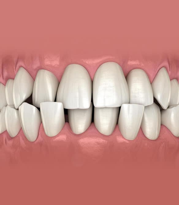 Correctable-Orthodontic-Problems