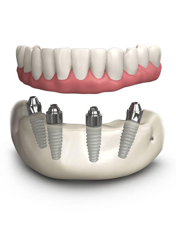 Dental-Implant-All-on-Four-Teeth-in