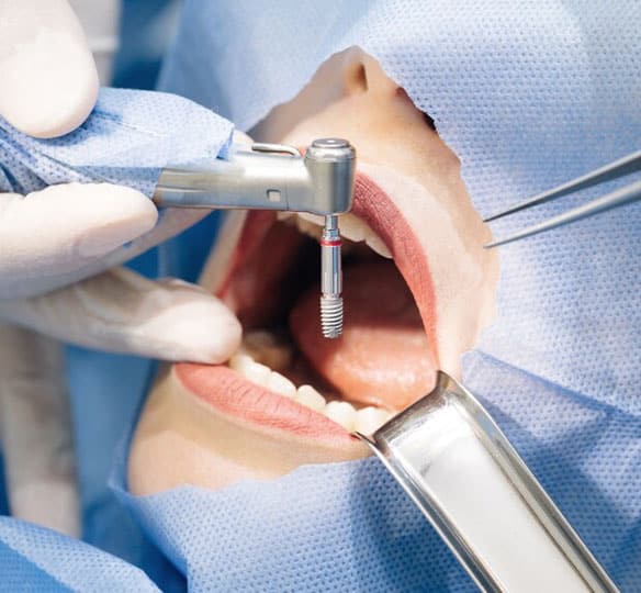 Dental-Implant-Placement-Methods