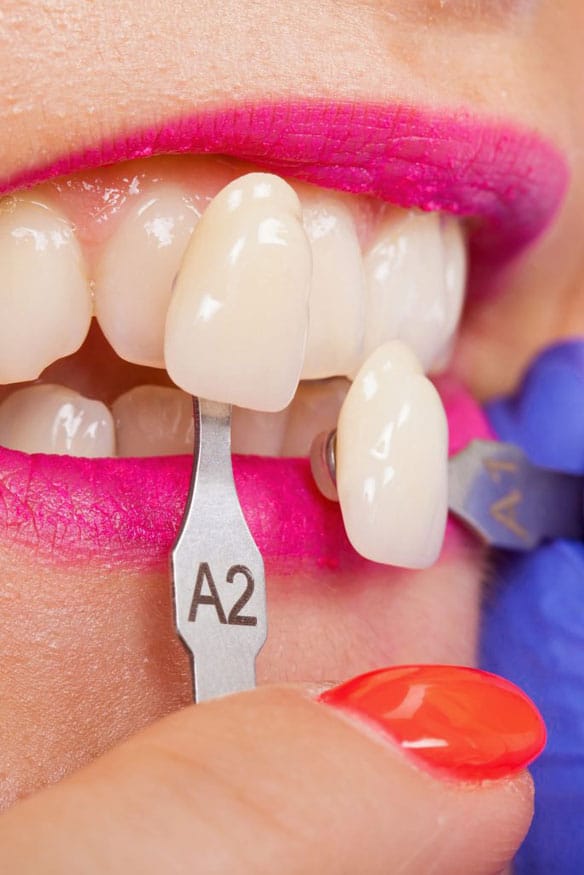 Dental-Veneer-Placement