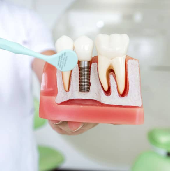 Dental-implant-Risks