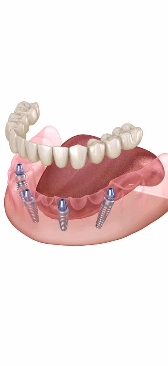 Implant-Retained-Dentures
