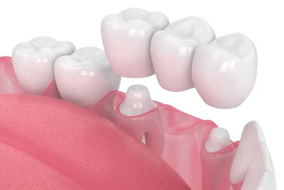 All-Ceramic-crown