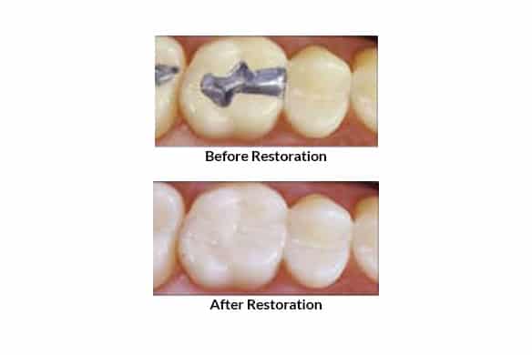 Tooth-colored Fillings | Gentle Family Dentist Avondale and Dental Implants