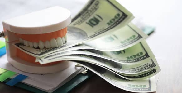 Veneers-costs