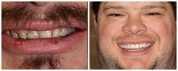 smile-full-mouth-rehabilitation-2