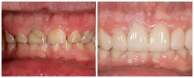 smile-full-mouth-rehabilitation-2a