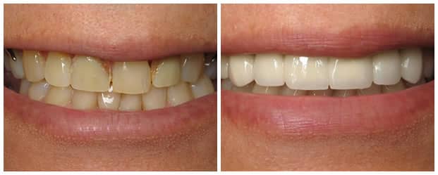 smile-makeover-all-ceramic-dental-crowns-2