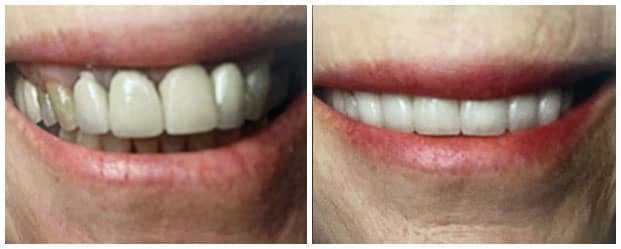 smile-makeover-all-ceramic-dental-crowns-veneers