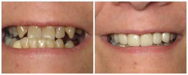 smile-makeover-all-ceramic-dental-crowns