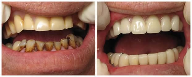 smile-makeover-ceramic-dental-crowns-veneers