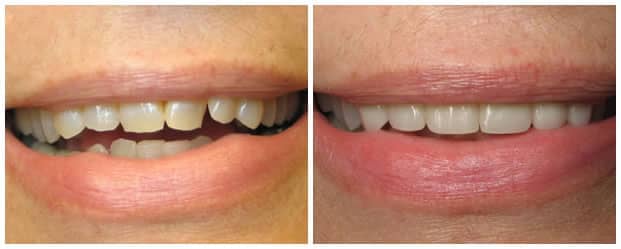 smile-makeover-ceramic-dental-crowns