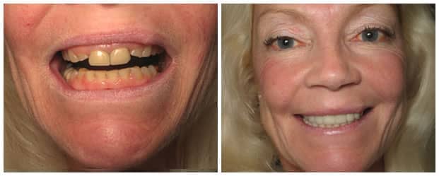 smile-makeover-dental-crowns-full-mouth-restoration