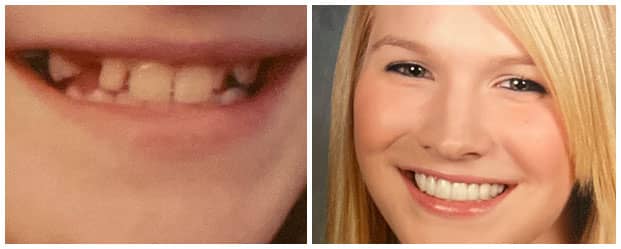 smile-makeover-dental-crowns-orthodontics