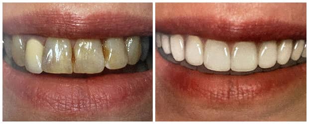 smile-makeover-dental-crowns-upper-porcelain