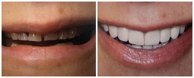 smile-makeover-dental-crowns-veneers
