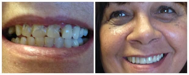 smile-makeover-dental-veneers-7