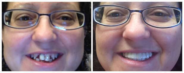 smile-makeover-full-mouth-restoration-dental-crowns-veneers-2a