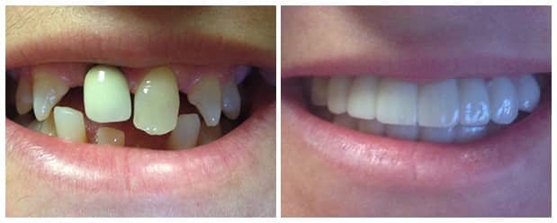 smile-makeover-full-mouth-restoration-dental-crowns-veneers-2b
