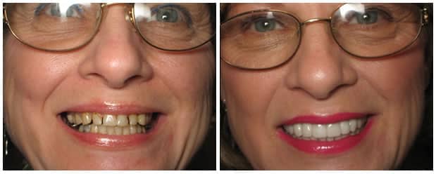 smile-makeover-full-mouth-restoration-dental-crowns-veneers-3