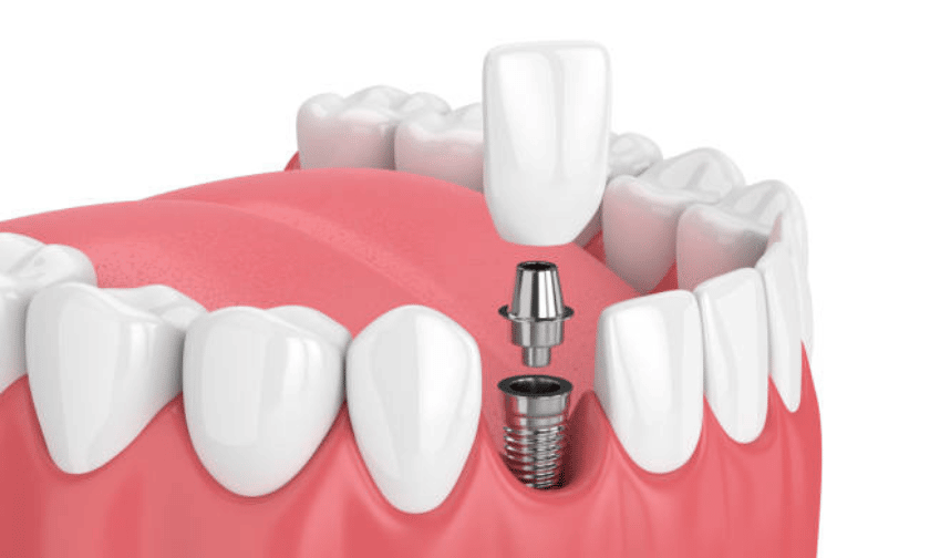 5 Common Myths About Dental Implants