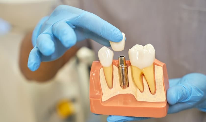 dental-implant