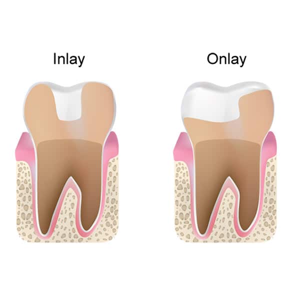 Restoration Dentistry | Gentle Family Dentist Avondale and Dental Implants