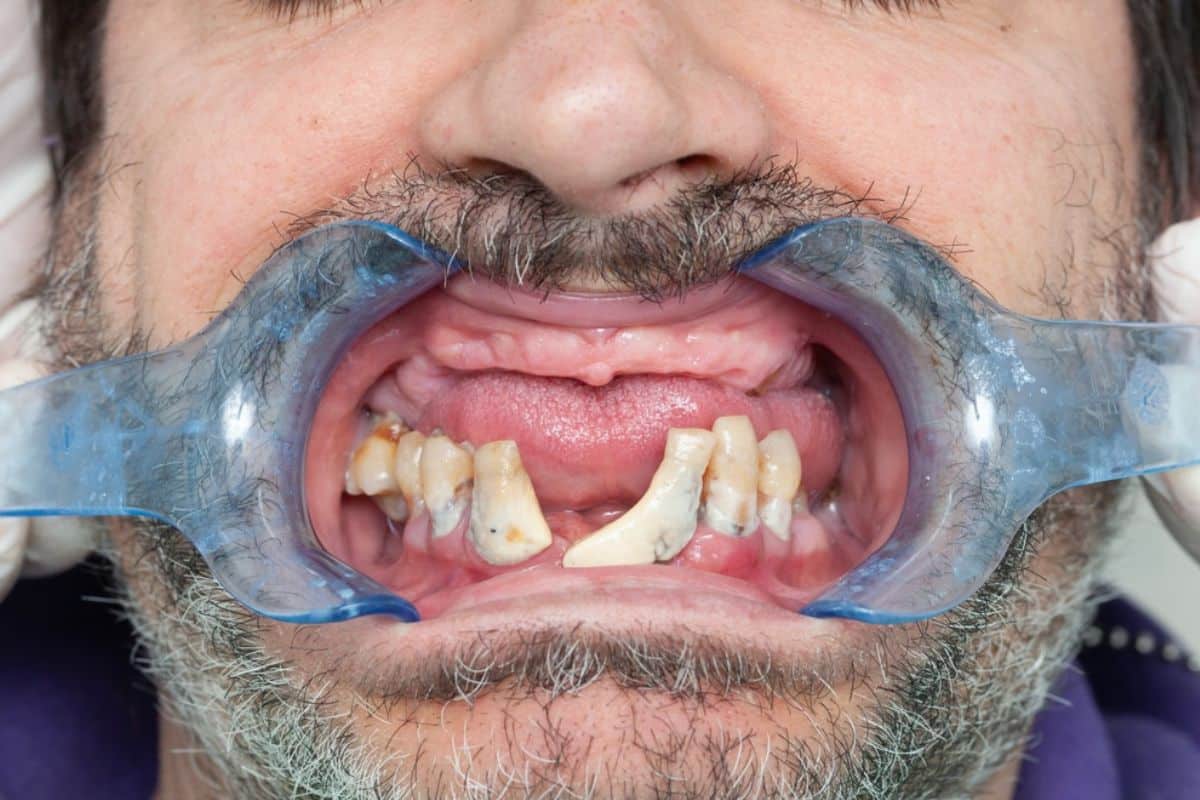 periodontal Early Symptoms - Gum disease Treatment in Avondale, AZ at Gentle Family Dentist Avondale and Dental Implants
