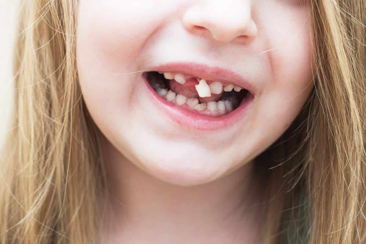 Featured image for “Chipped or Broken Tooth: Immediate Actions to Prevent Further Damage”