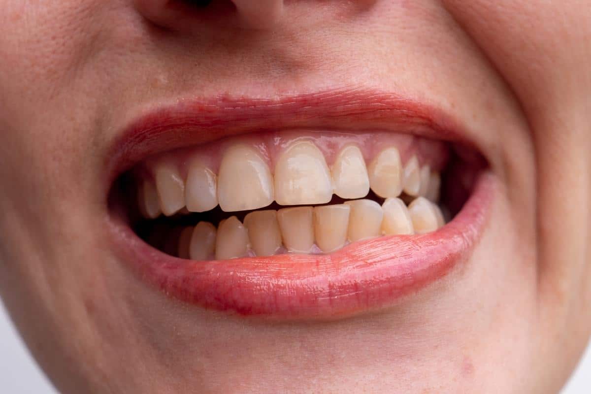 Featured image for “Real Solutions for Stubborn Tooth Stains”