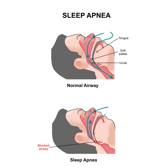 Signs and Symptoms of Sleep Apnea